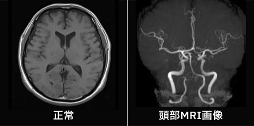 正常画像と頭部MRI画像