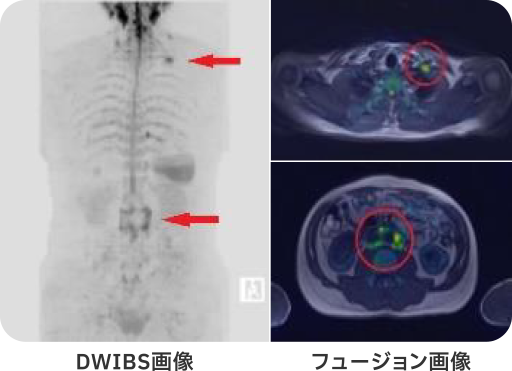 DWIBS画像とフュージョン画像